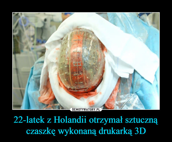22-latek z Holandii otrzymał sztuczną czaszkę wykonaną drukarką 3D –  