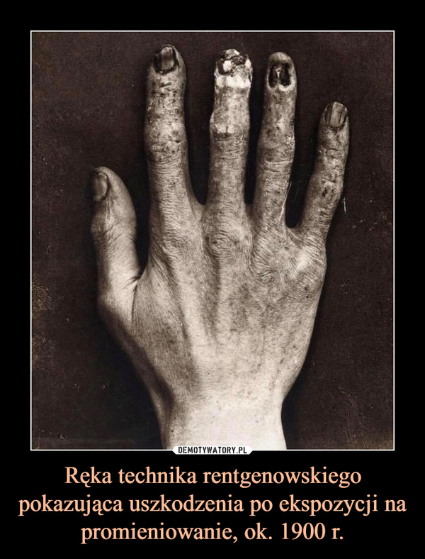 Ręka technika rentgenowskiego pokazująca uszkodzenia po ekspozycji na promieniowanie, ok. 1900 r. –  