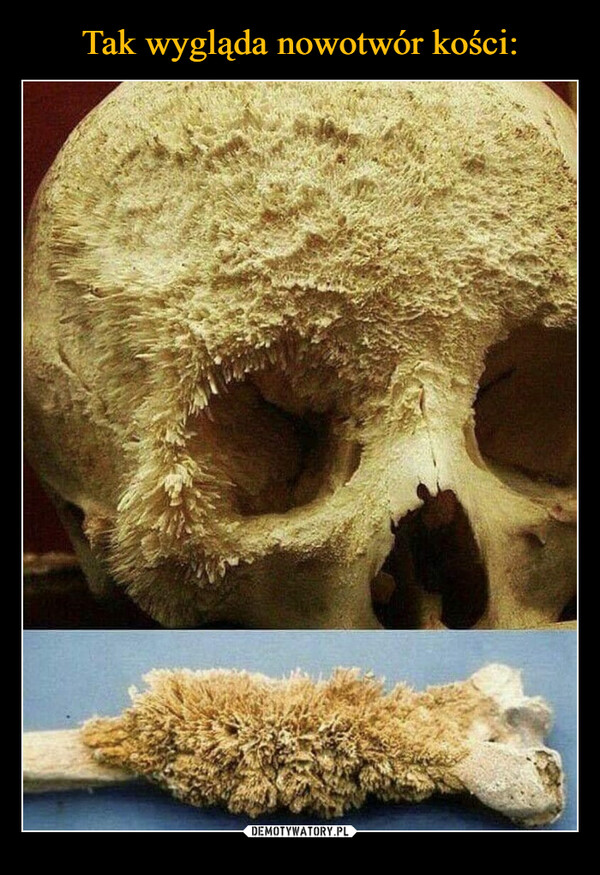 Tak wygląda nowotwór kości:
