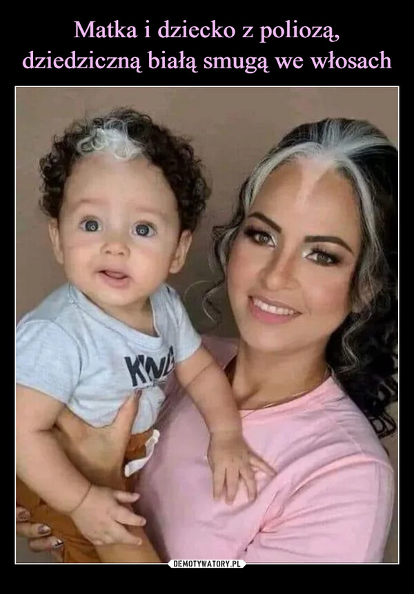 Matka i dziecko z poliozą, dziedziczną białą smugą we włosach